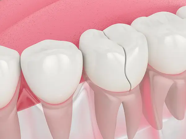 Close-up of a tooth in the lower jaw with a deep, significant crack in need of repair at Radiance Dental in West Chester, PA