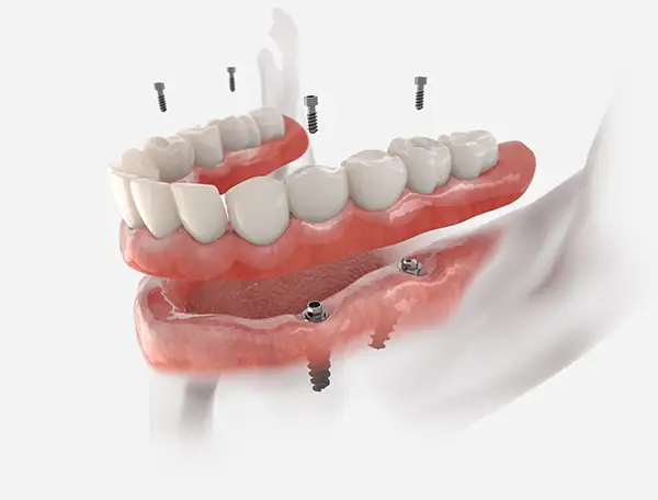 Upper and lower implant-supported dentures being attached to titanium implants illustrated by Radiance Dental in West Chester, PA
